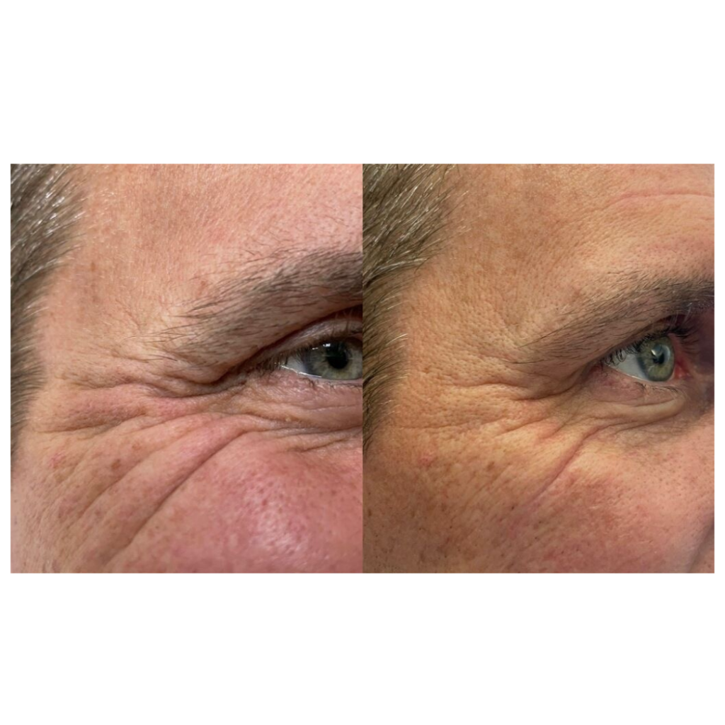 NuVissa Plasma Pen before and after results Crows Feet