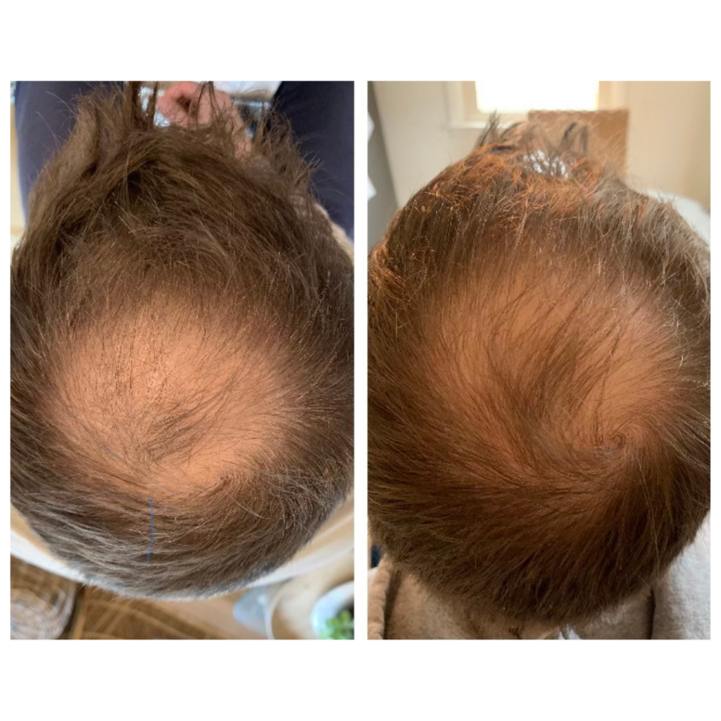 NuVissa Plasma Pen before and after results Hair Restoration