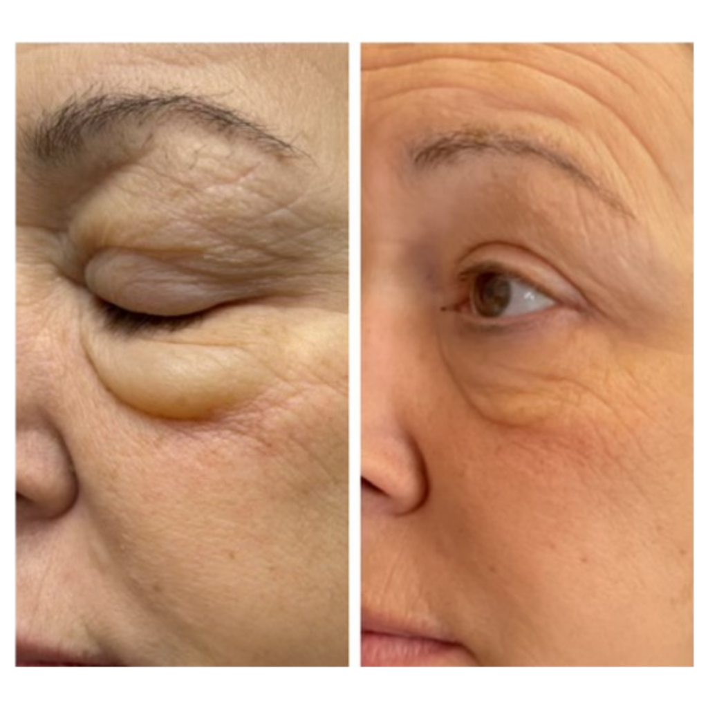 NuVissa Plasma Pen before and after results Eyelid Lift