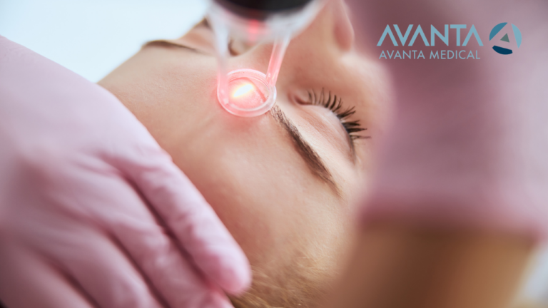 Close-up of a CO2 laser treatment on a patient's face, targeting fine lines and imperfections with AVANTA Medical technology