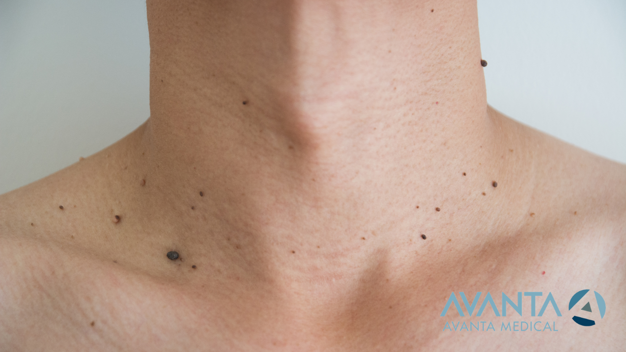 Close-up of a person's neck and chest showing multiple skin tags, with AVANTA Medical branding.